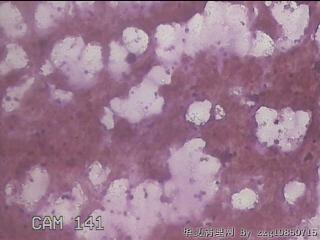 左甲状腺肿物穿刺标本图25