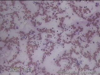 右甲状腺肿物穿刺标本图15