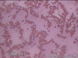 右甲状腺肿物穿刺标本图26