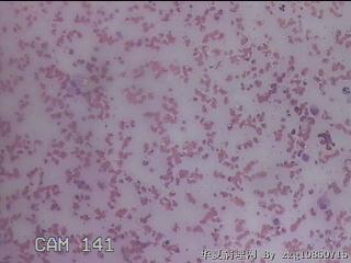 右甲状腺肿物穿刺标本图23