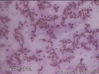 右甲状腺肿物穿刺标本图21
