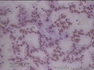 右甲状腺肿物穿刺标本图17