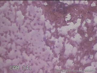 左甲状腺肿物穿刺标本图24