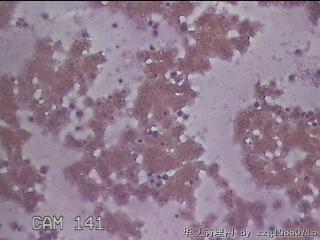 右甲状腺肿物穿刺标本图13