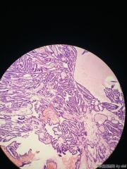 甲状腺内乳头状物，感觉核的异型性还不够癌，请教大师！！图4