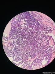 甲状腺内乳头状物，感觉核的异型性还不够癌，请教大师！！图1