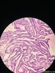甲状腺内乳头状物，感觉核的异型性还不够癌，请教大师！！图6