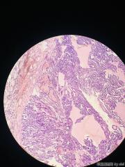 甲状腺内乳头状物，感觉核的异型性还不够癌，请教大师！！图2