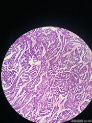 甲状腺内乳头状物，感觉核的异型性还不够癌，请教大师！！图10