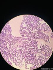 甲状腺内乳头状物，感觉核的异型性还不够癌，请教大师！！图5
