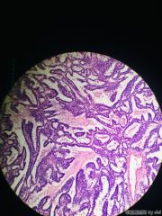 甲状腺内乳头状物，感觉核的异型性还不够癌，请教大师！！图15