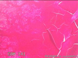 甲状腺结节图12