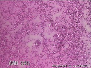 甲状腺穿刺液图3