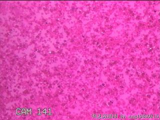 甲状腺穿刺液图18