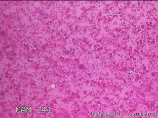 甲状腺穿刺液图14