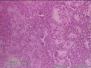 甲状腺穿刺液图2