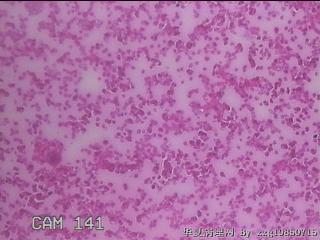 甲状腺穿刺液图17