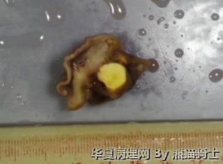 远端胃十二指肠肿物图1