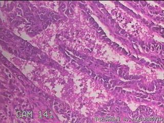 宫颈赘生物图32