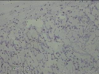 膝关节积液4ml图21