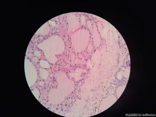 甲状腺嗜酸细胞镜下结节1mm，乳头状癌吗图1