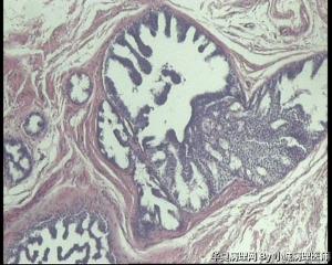 急！请教老师，73岁左乳腺多发性囊性肿物图15