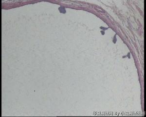 急！请教老师，73岁左乳腺多发性囊性肿物图4