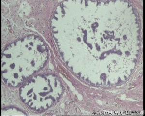急！请教老师，73岁左乳腺多发性囊性肿物图5