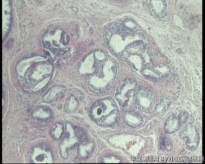 急！请教老师，73岁左乳腺多发性囊性肿物图14