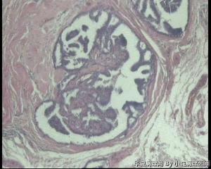 急！请教老师，73岁左乳腺多发性囊性肿物图8