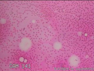 左侧甲状腺包块穿刺液图14