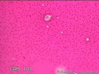 左侧甲状腺包块穿刺液图15