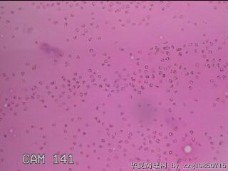 左侧甲状腺包块穿刺液图3