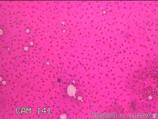 左侧甲状腺包块穿刺液图17