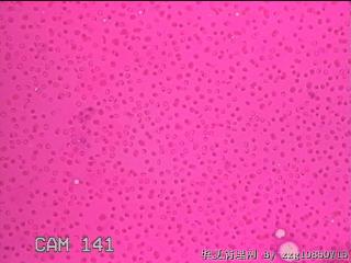 左侧甲状腺包块穿刺液图16