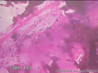 右侧甲状腺穿刺液图30