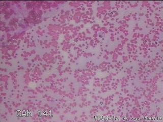右侧甲状腺穿刺液图4