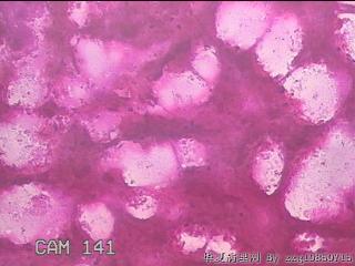 右侧甲状腺穿刺液图24