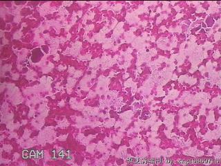 右侧甲状腺穿刺液图19