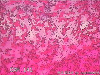 右侧甲状腺穿刺液图28