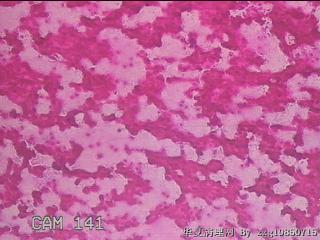 右侧甲状腺穿刺液图17