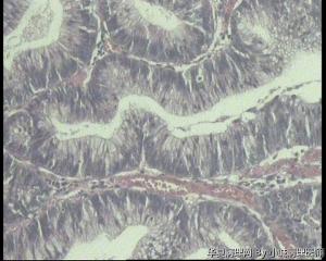 66岁，绒毛管状腺瘤，低级别没有高级别病变倾向吧？图12