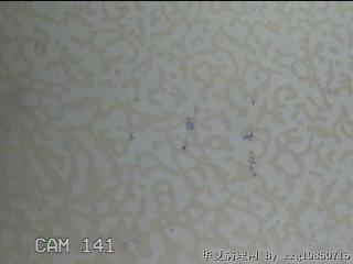 左侧甲状腺细针穿刺涂片图27