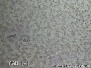 右侧甲状腺细针穿刺涂片图4