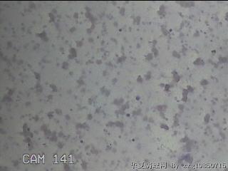 右侧甲状腺细针穿刺涂片图16