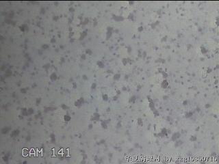 右侧甲状腺细针穿刺涂片图15