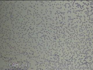 右侧甲状腺细针穿刺涂片图28