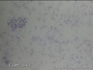 右侧甲状腺细针穿刺涂片图7