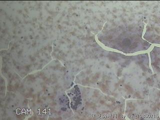右侧甲状腺细针穿刺涂片图8