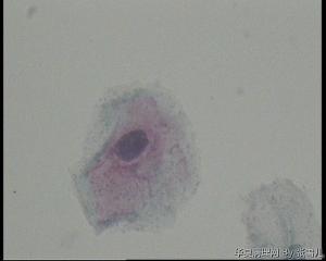 28岁TCT，ASC—US吗？图9